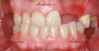 clinica dental alustiza falta de piezas dentales