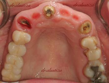 clinica dental alustiza implantes dentales