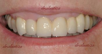 clinica dental alustiza despues implantes dentales