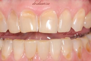 clinca dental alustiza bilbao lesiones cervicales
