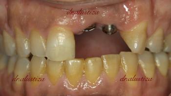 clinica dental bilbao alustiza perdidad de piezas