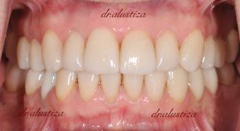 clinica dental alustiza bilbao implantes dentales despues