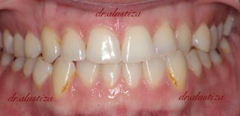 clinica dental alustiza bilbao sensibilidad dental