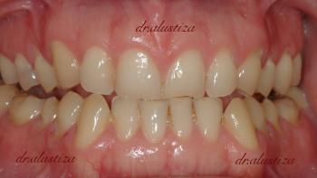clinica dental alustiza bilbao carillas