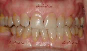 clinica dental alustiza bilbao desgaste dental