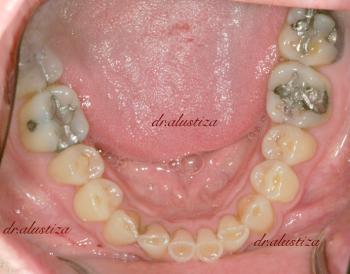 clinica dental bilbao alustiza reconstrucción
