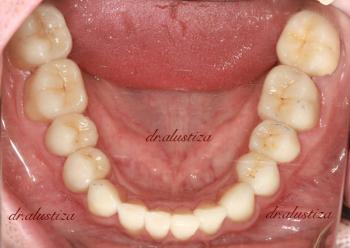 clinica dental bilbao alustiza reconstruccion resultado