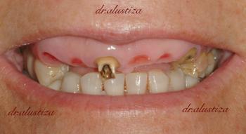 clinica dentales alustiza antes de implantes