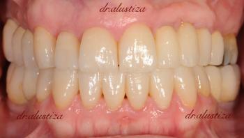 clinica dental bilbao alustiza recontruccion de piezas dentales