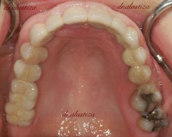 clinica dental alustiza implantes dentales