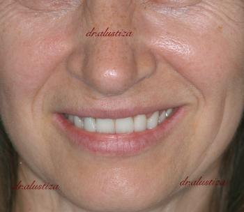 clinica dental bilbao alustiza implantes dentales despues