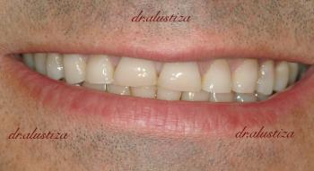 clinica dental bilbao alustiza carillas