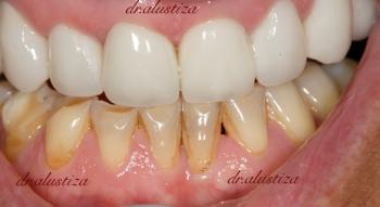 clinica dental bilbao alustiza carillas