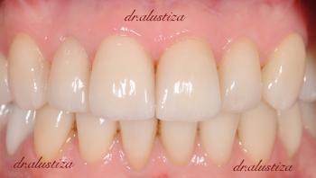 clinica dental alustiza bilbao desgaste despues