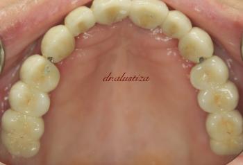 clinica dental bilbao alustiza reparación estetica