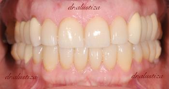 clinica dental bilbao alustiza implantes dentales