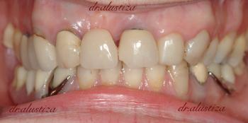 clinica dental bilbao alustiza implantes dentales