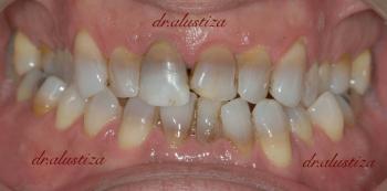 clinica dental alustiza bilbao antes