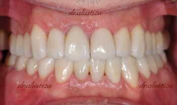 clinica dental alustiza bibao despues