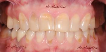 clinica dental alustiza bilbao carillas