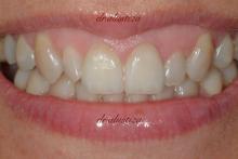 clinica dental alustiza bilbao endodoncia