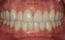 clinica dental alustiza implantes dentales fijos