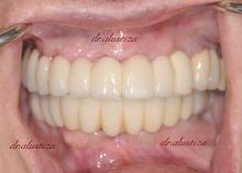 clinica dental bilbao alustiza reparación estetica