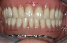 clinica dental alustiza bilbao protesis fija 